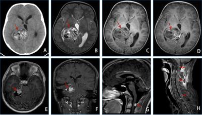 Malignant transformation of desmoplastic infantile tumors in a non-infant: a case report